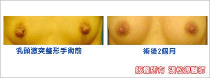 乳頭整形手術案例3.jpg