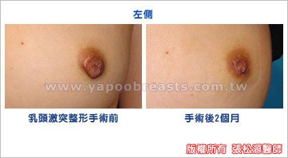 乳頭整形手術案例2.jpg