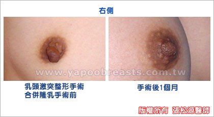 乳頭整形合併隆乳手術案例2.jpg