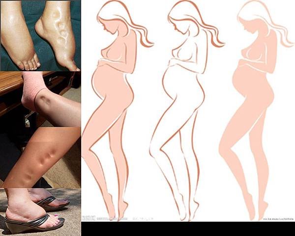 妊娠水腫﹝Gestational_Edema﹞