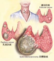 甲狀腺﹝thyroid﹞：A