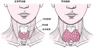 甲狀腺﹝thyroid﹞：imagesCAV5BPF2