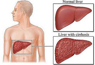 第11節　肝硬化﹝Cirrhosis_of_Liver﹞：liver-cirrhosis.jpg