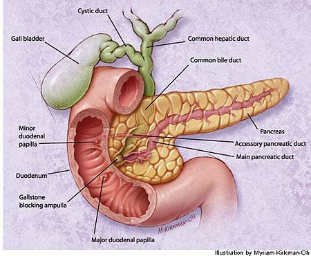 Acute_Pancreatitisafp20000701p164-f1.jpg