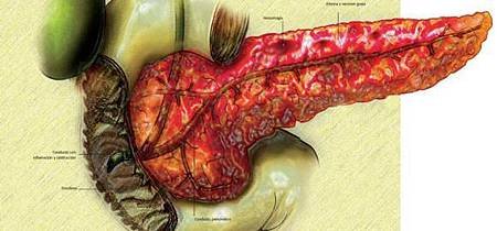 急性胰腺炎-acute-pancreatitis.jpg