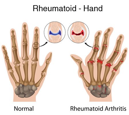 風濕性關節炎﹝rheumatic_arthritis﹞：rheumatoid-arthritis-hand