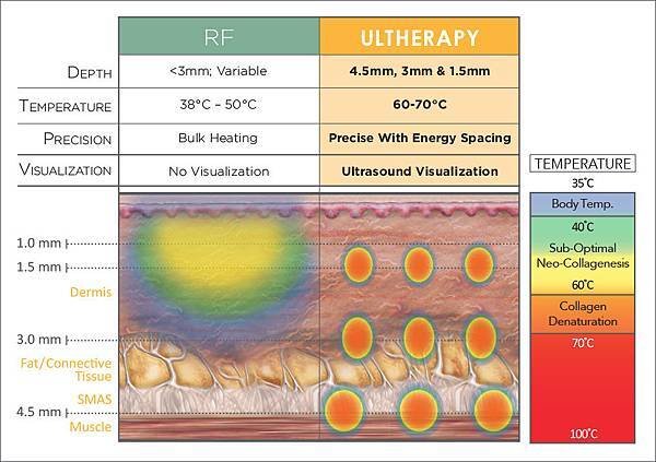 ulthera