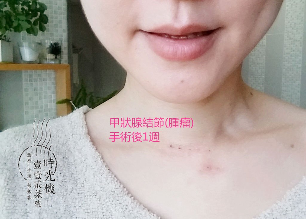 告別甲狀腺腫瘤 (35).jpg