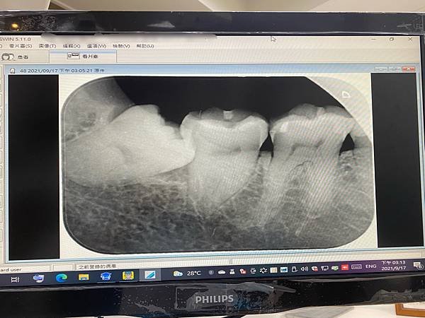 水平智齒，拔牙前X光的樣子，真的是長橫的