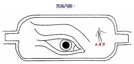 19-黑風內障：
