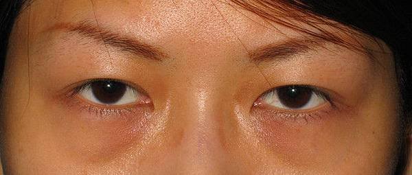 案例照片-眼袋內開+補脂術前術後