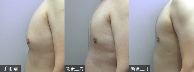 改善並治療女乳症，女乳症手術前，不可不知的事！｜蘇毓彬醫師.jpg