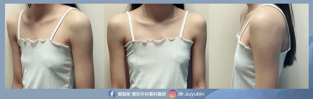 重建隆乳-術前.jpg