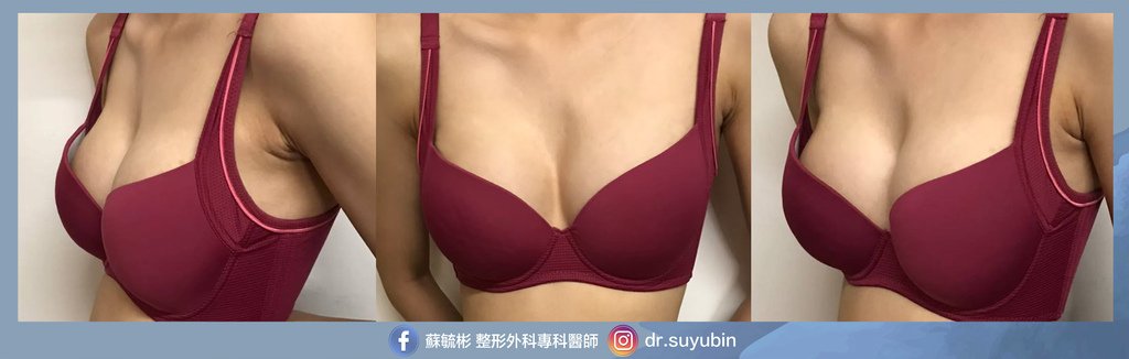 重建隆乳-術後.jpg