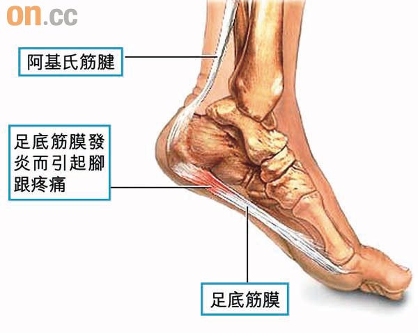 腳(足)底肌膜炎